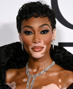 Winnie Harlow modele vitiligo